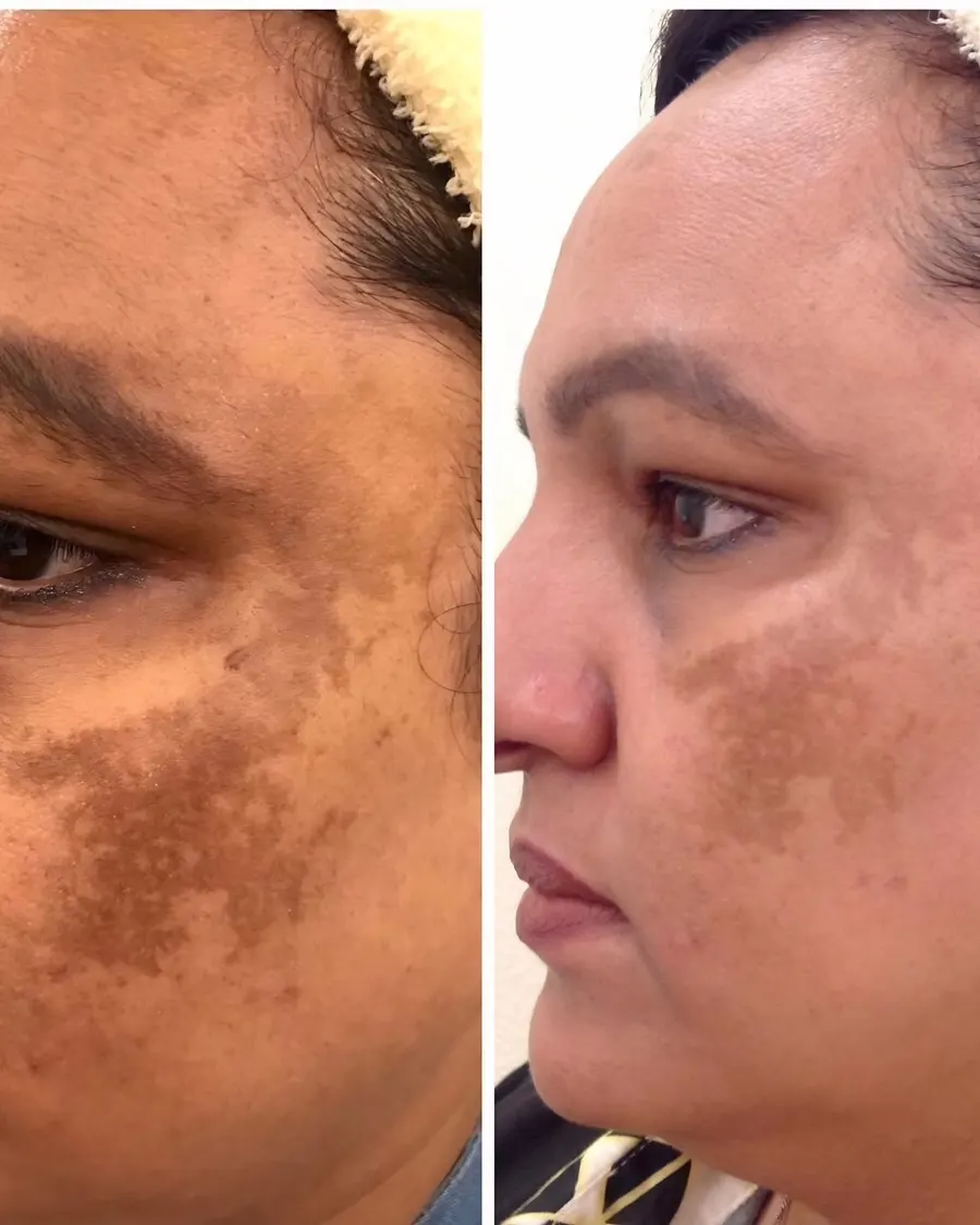 Advanced Laser Treatment for Pigmentation at Cinch Clinics